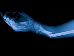 Ilmuwan China Ciptakan Adhesif Tulang, Sekali Suntik Patah Tulang Sembuh Di 3 Menit