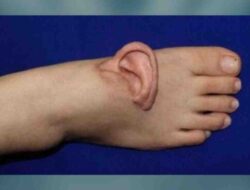 Ahli Bedah China Pindahkan Telinga Wanita Ke Kaki Di 5 Bulan