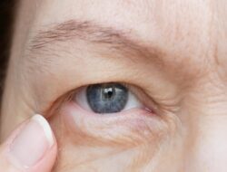 Mengenal Ptosis, Kebugaran Kelopak Mata yang Disindir Praktisi Medis Tompi